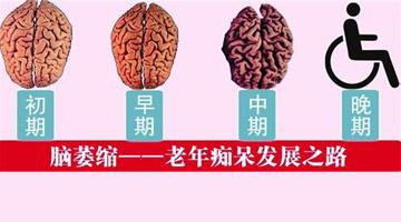 轻微脑萎缩能治好吗?找准发病原因是关键