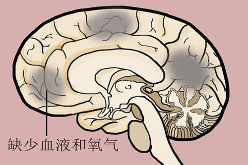 经颅磁刺激仪|脑梗塞有哪些明显的症状特征?