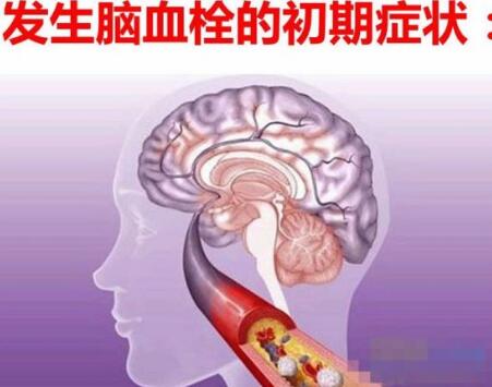 家用经颅磁刺激仪——有脑血栓人多吃什么好
