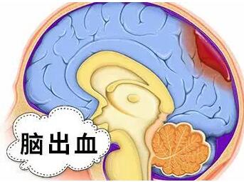 经颅磁刺激仪怎么样?脑溢血发生前有什么异常