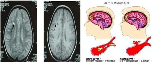 经颅磁刺激应用领域_脑血栓应该挂哪个科室