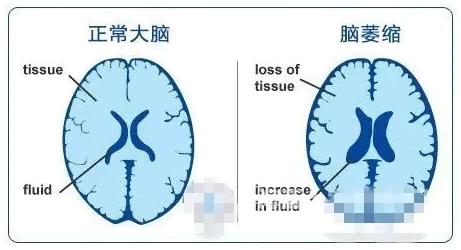 rtms经颅磁治疗仪_老年性脑萎缩症状表现有哪些 