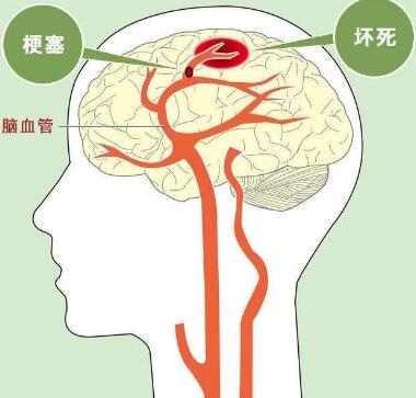 经颅磁刺激技术_脑血栓怎么预防和治疗 