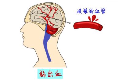 择思达斯经颅磁_预防脑出血怎么治疗哪些疾病