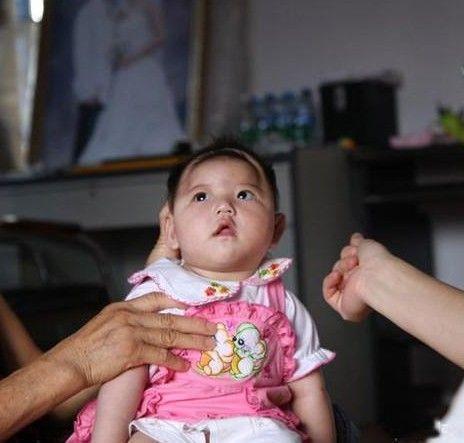 家用经颅磁治疗脑瘫的作用