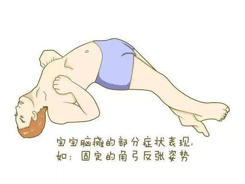 经颅磁刺激仪治疗安全吗?轻度脑瘫儿能否治好