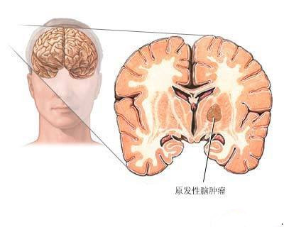择思达斯经颅磁怎么样?癫痫病的自我康复和护理 