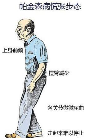 择思达斯经颅磁刺激仪_帕金森治疗的黄金期