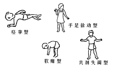 择思达斯经颅磁刺激_家里有脑瘫孩子的心酸