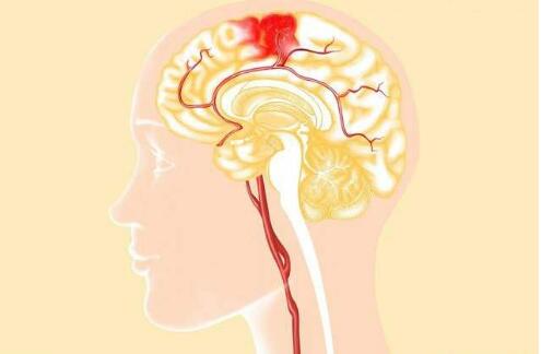 经颅磁刺激治疗仪_脑出血有什么诊断的依据 